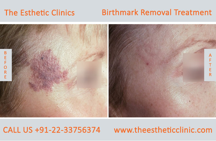Birthmarks Removal Treatment before after photos in mumbai india (7)